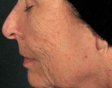 Before Deep FX treatment: a woman's profile and cheek in close-up with deeper wrinkles