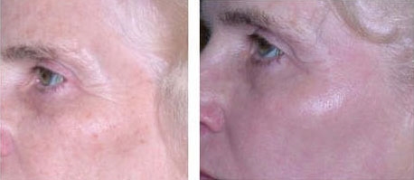 Before and after CO2 laser resurfacing: a close-up of an older woman's eye area with fine lines before, and smoother skin after