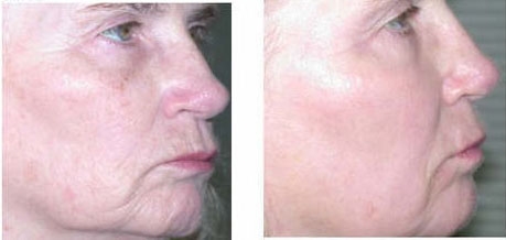Before and after ablative resurfacing: a woman's face in profile, with fewer wrinkles and spots in the after photograph on the right