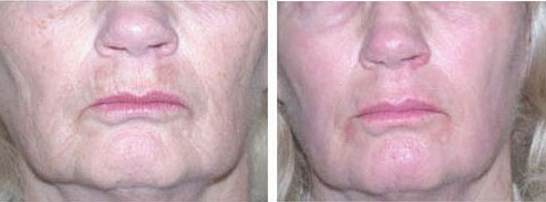 Before and after ablative resurfacing: front view of a woman's lower face, with smoother, more even skin in the after photograph on the right