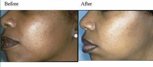 Before and after chemical peels: side view of a woman's face, with the labels Before and After printed above the two photographs