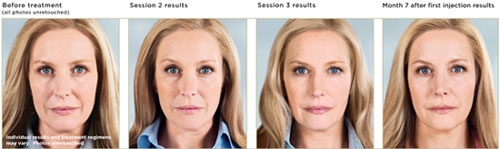 Sculptra results: four photographs of one woman's face labeled Before treatment, Session 2 results, Session 3 results and Month 7 after first injection