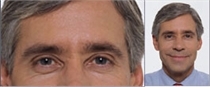 After Botox: close view of a man's eyes and forehead beside a smaller smiling portrait of him in a blue shirt
