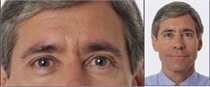 Before Botox: close view of a man's eyes and forehead beside a smaller portrait of him in a blue shirt