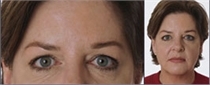 After Botox: close view of a woman's eyes and forehead beside a smaller portrait of her in a red top