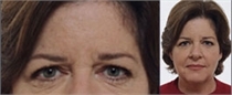 Before Botox: close view of a woman's eyes and forehead beside a smaller portrait of her in a red top