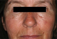 After Nd:YAG laser treatment: front view of a person's face with the eyes covered by a black bar