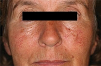 Before Nd:YAG laser treatment: front view of a person's face with the eyes covered by a black bar and visible redness on the cheeks