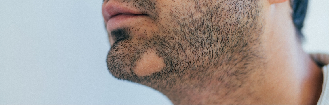 Stock photograph of a model: a man's chin with a beard that has one small bare round patch