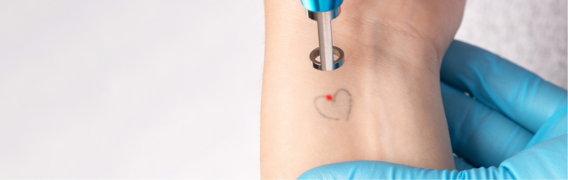 Stock photograph: a blue-gloved hand holds a laser handpiece with a red light over a faded small heart tattoo on a wrist