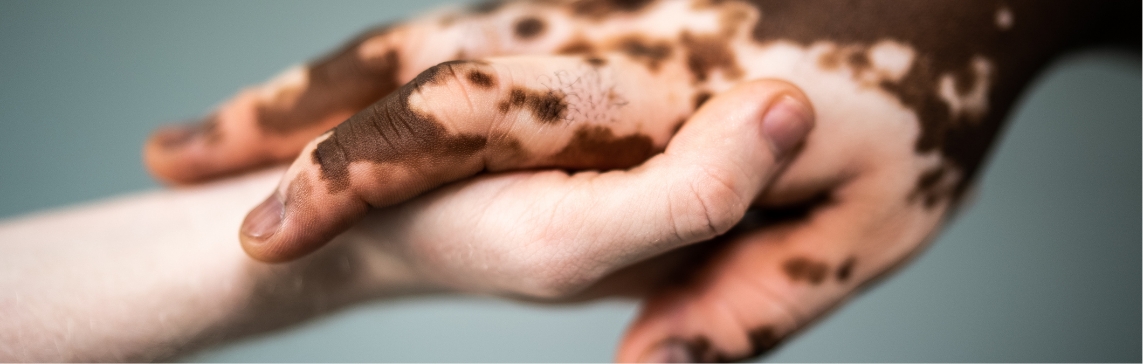 Stock photograph of models: two hands clasped, one with patchy light and dark areas of skin pigmentation