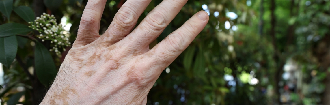 Stock photograph: the back of a hand with light brown patches held up against green foliage