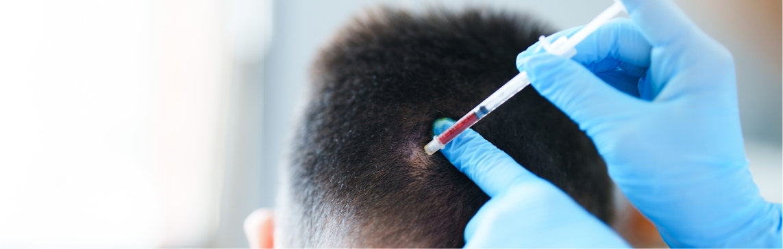Stock photograph of a model: blue-gloved hands inject a syringe with red-tinged fluid into the scalp of a man with short dark hair