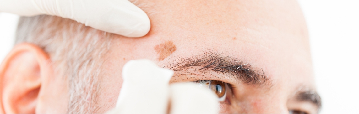 Stock photograph of a model: gloved hands examine a brown patch on the forehead of a bald, grey-haired man