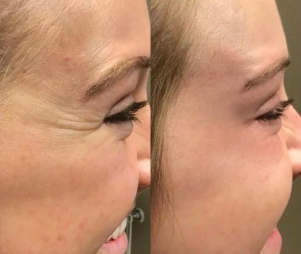 Before and After Image: Botox - right-side; before on the left, after on the right