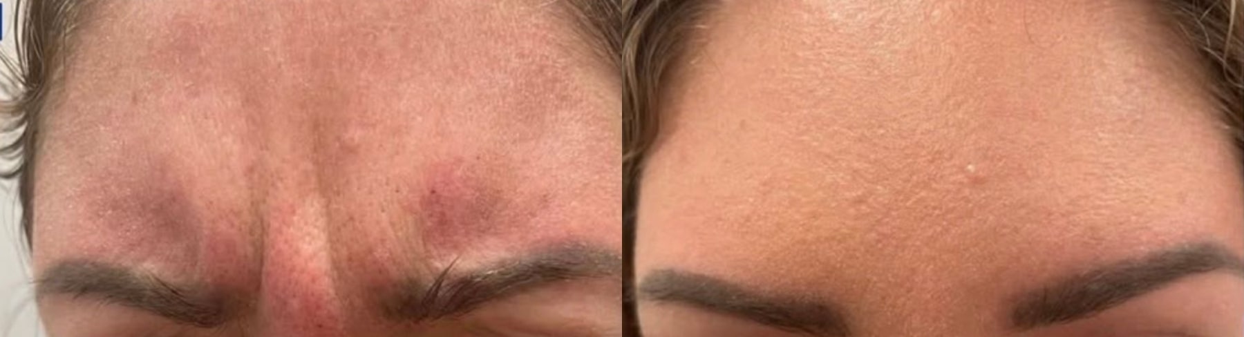 Before and After Image: Botox2 - front; before on the left, after on the right