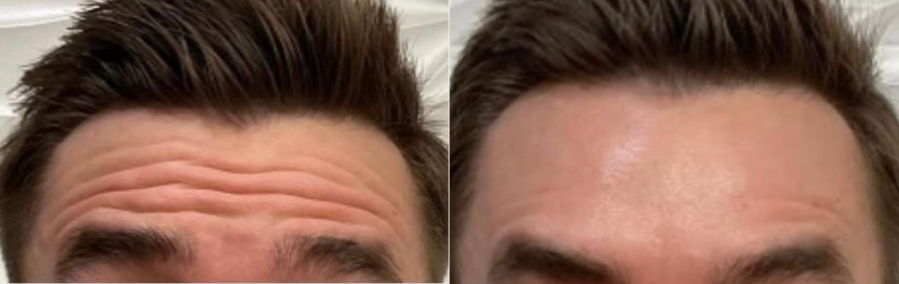 Before and After Image: Botox 3 - front; before on the left, after on the right