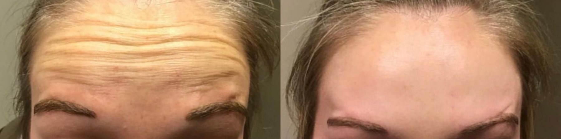Before and After Image: Botox 4 - front; before on the left, after on the right