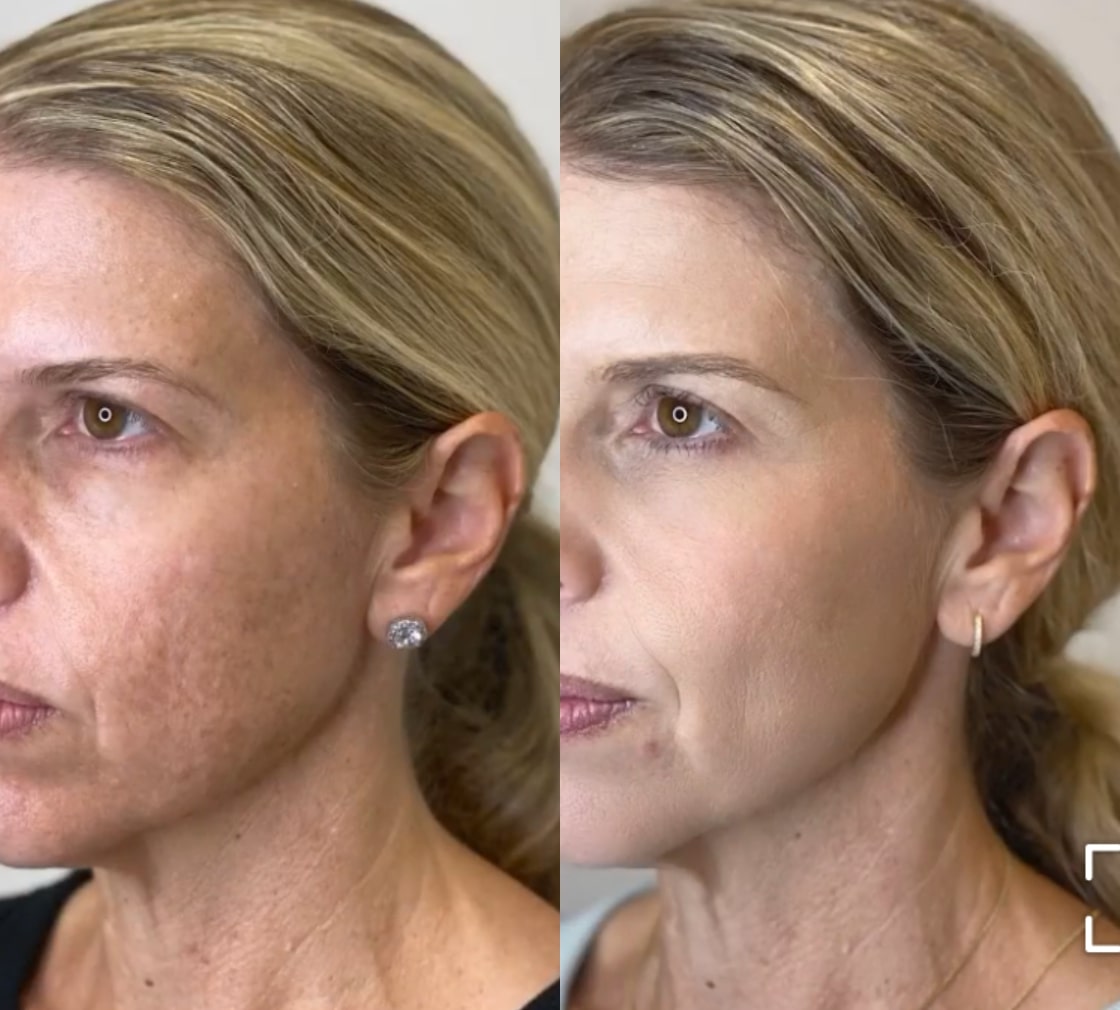 Before and After Image: Chemical Peel - left-side; before on the left, after on the right