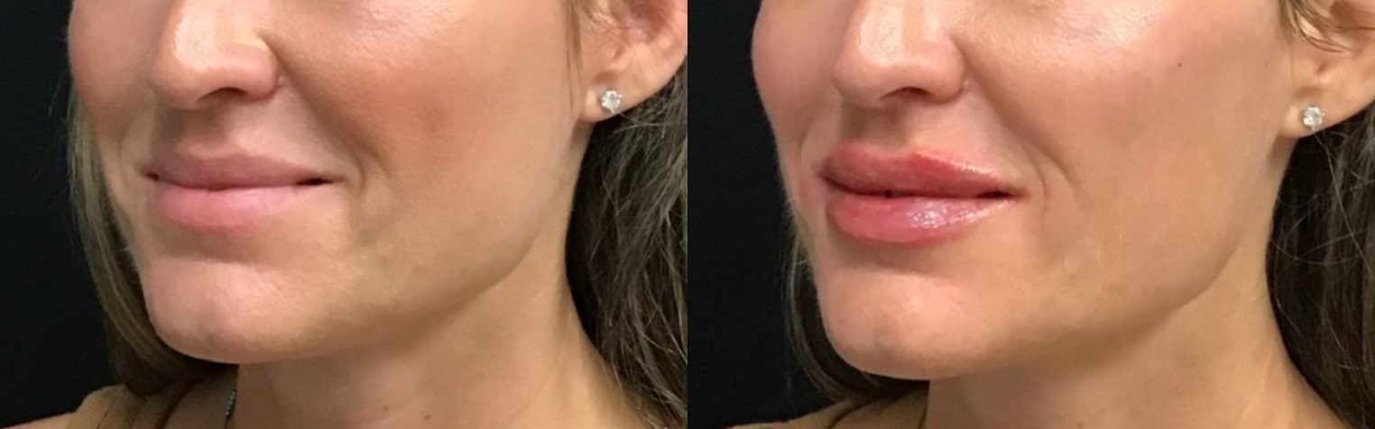 Before and After Image: Fillers - front; before on the left, after on the right