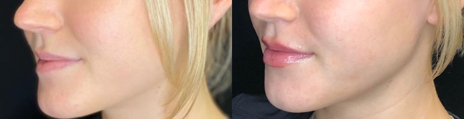 Before and After Image: Fillers - front; before on the left, after on the right