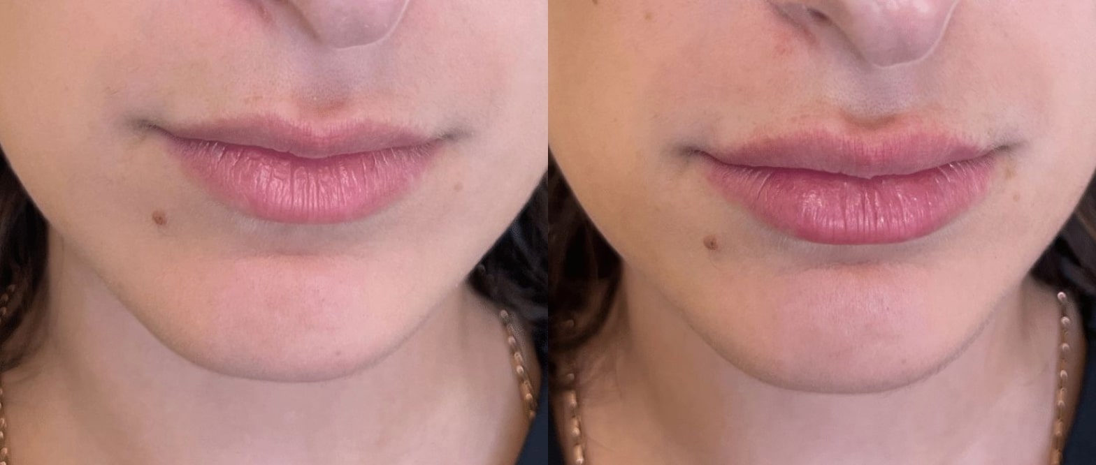 Before and After Image: Fillers - front; before on the left, after on the right