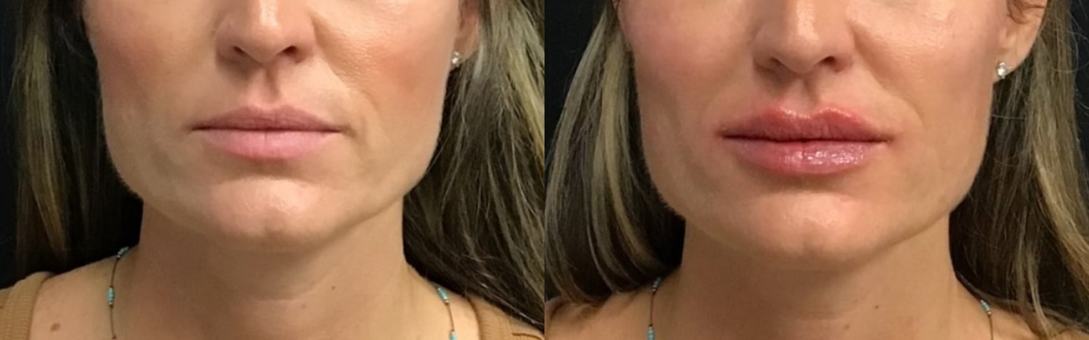 Before and After Image: Fillers - front; before on the left, after on the right