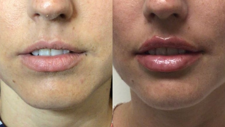 Before and After Image: Fillers - front; before on the left, after on the right