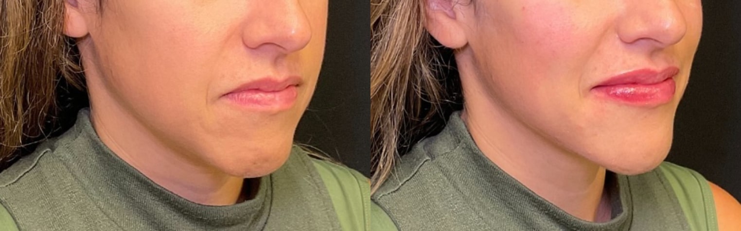 Before and After Image: Fillers - front; before on the left, after on the right