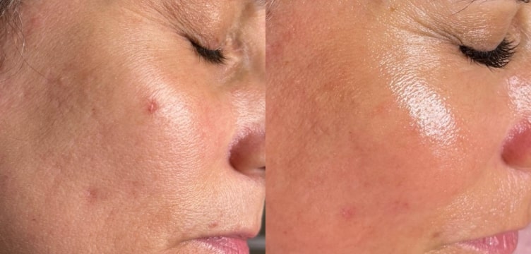 Before and After Image: Microneedling - right-side; before on the left, after on the right