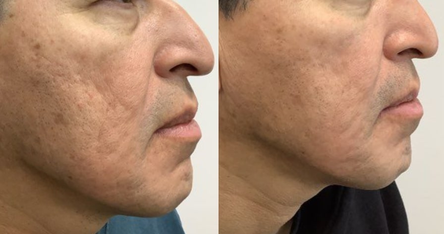 Before and After Image: Microneedling - right-side; before on the left, after on the right