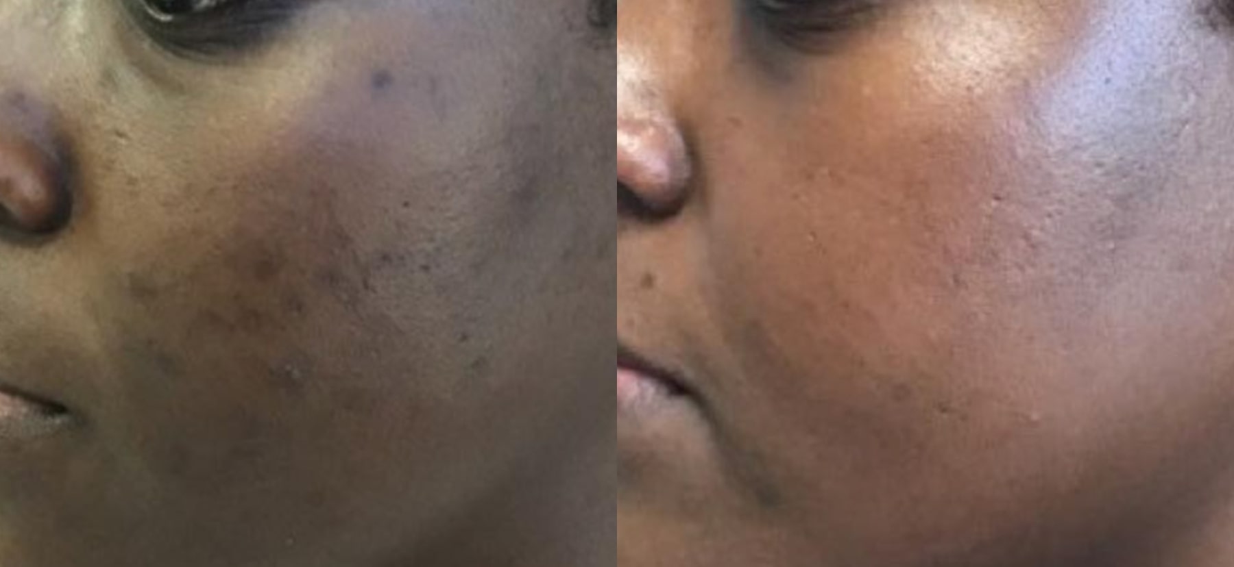 Before and After Image: Microneedling - left-side; before on the left, after on the right