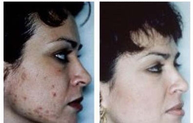 before and after microdermabrasion 3
