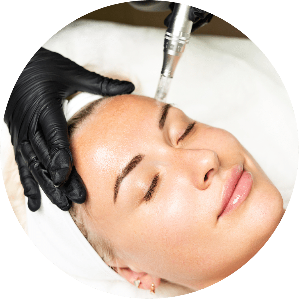 Microneedling